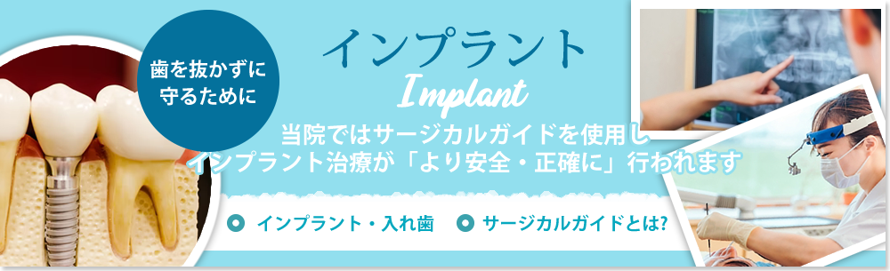 implant|インプラント